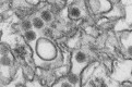 US issues treatment guidelines for infants exposed to Zika